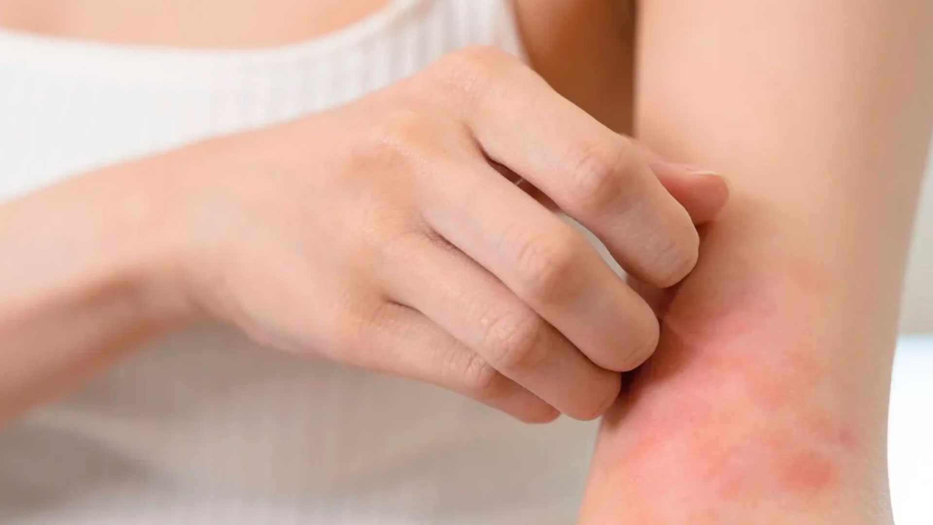 Seis mitos sobre la piel atópica