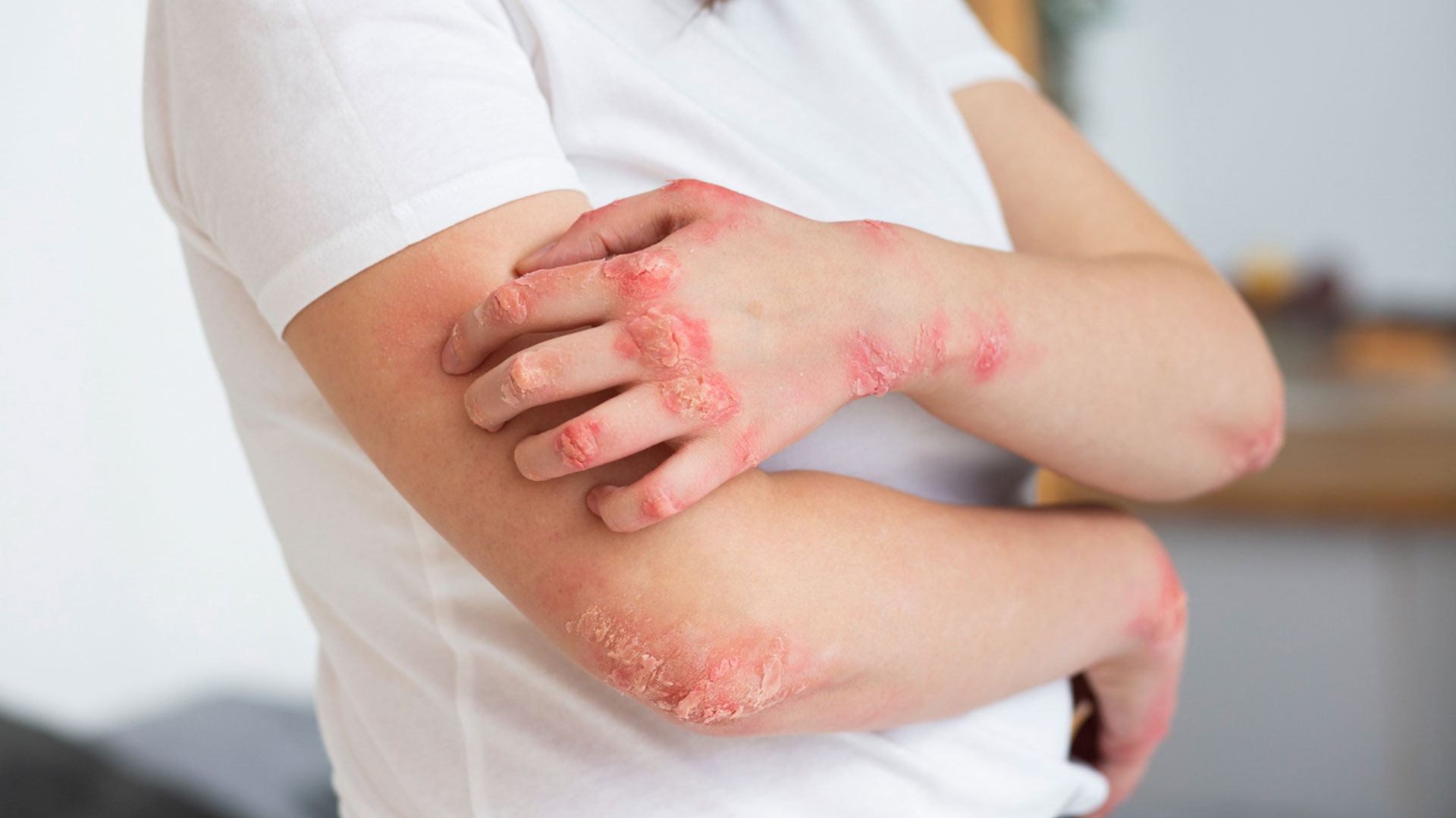 Destápate 2024: La campaña que desestigmatiza la psoriasis