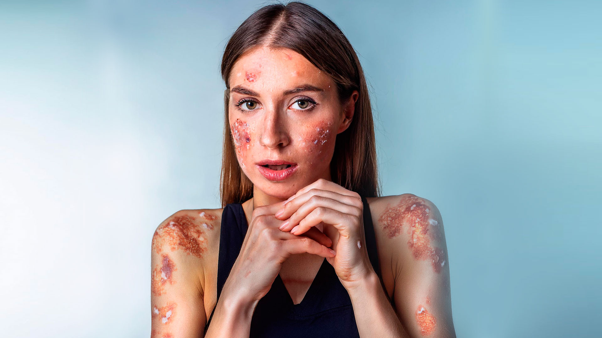 Relación entre Psoriasis y Depresión