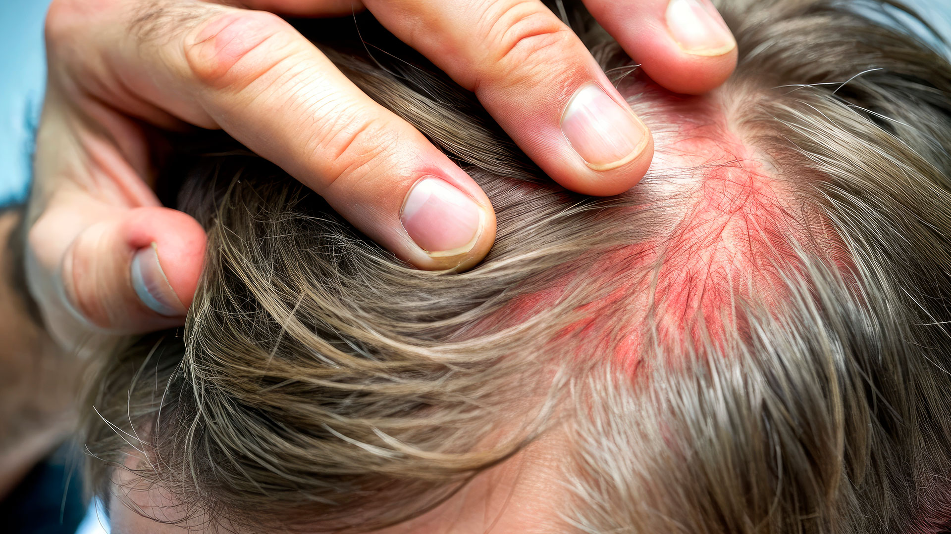 Persona con psoriasis agravada en invierno