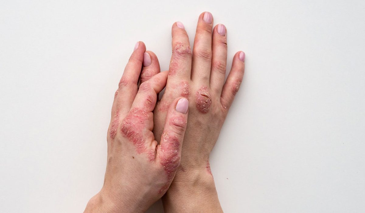 Posiblemente estemos mas cerca dela cura de la psoriasis