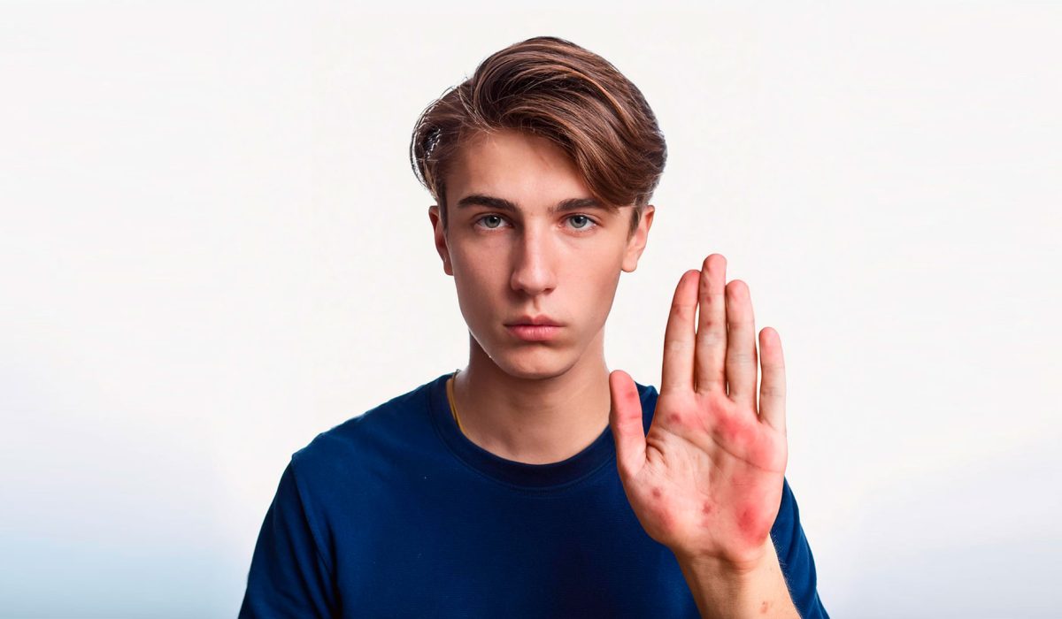 Joven con atopia en la palma de la mano