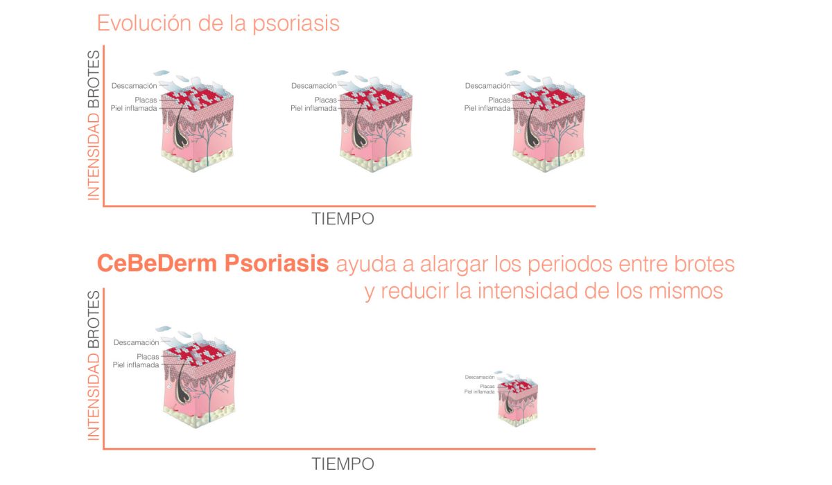 Alarga los periodos entre brotes de psoriasis y reduce la intensidad de los mismos