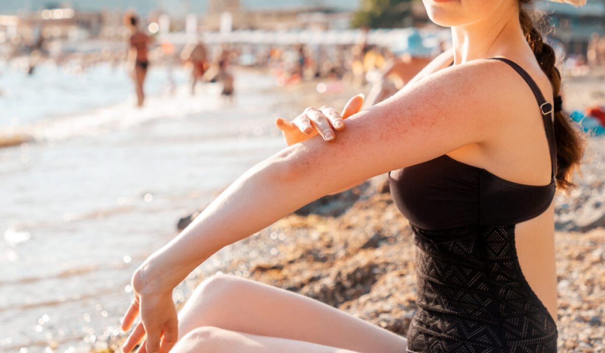 A woman in a swimsuit sits on the beach and scratches her hand with redness and a rash. Close up. Outdoor. Concept of insect bites and allergies.